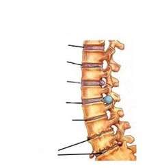 fasi di sviluppo dell'osteocondrosi