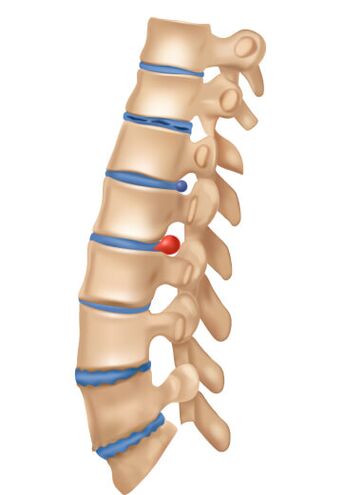 Come appare l'osteocondrosi deophrming