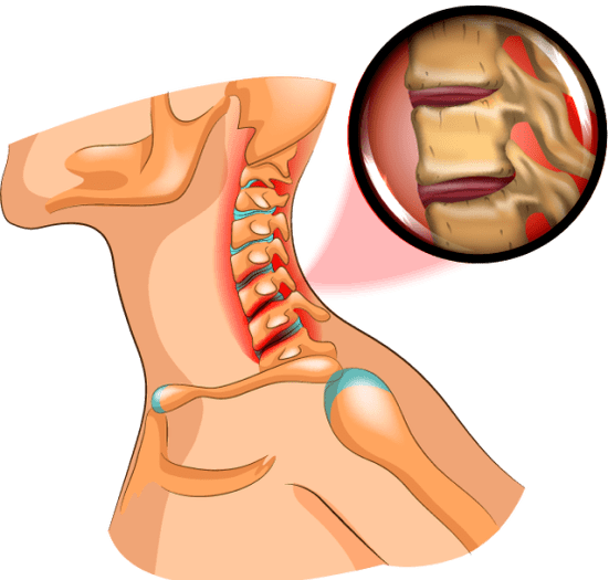 osteocondrosi al collo