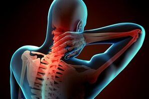 Osteocondrosi cervicale