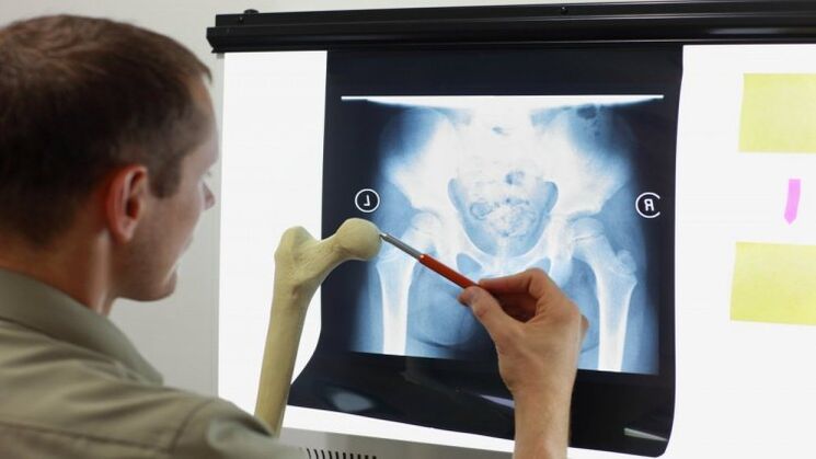 Il medico esamina una radiografia per l'artrosi dell'anca
