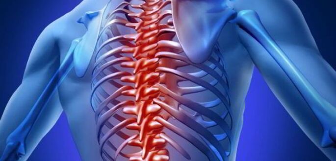 osteocondrosi della colonna vertebrale toracica